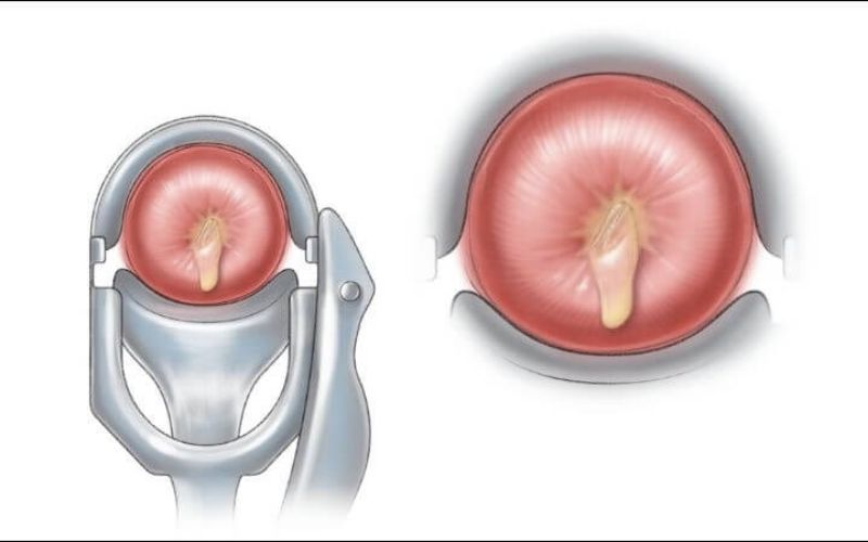 Cách phòng tránh viêm cổ tử cung