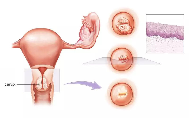Dấu hiệu của viêm cổ tử cung là gì? Các phòng bệnh