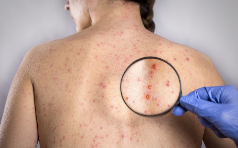 Tác động của Rubella đối với thai nhi