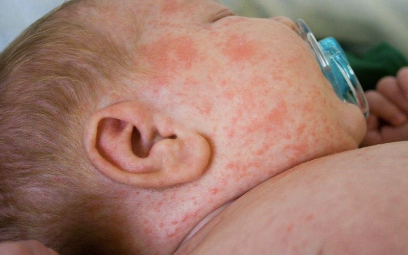 Rubella là bệnh gì? Triệu chứng và tác động đối với cơ thể