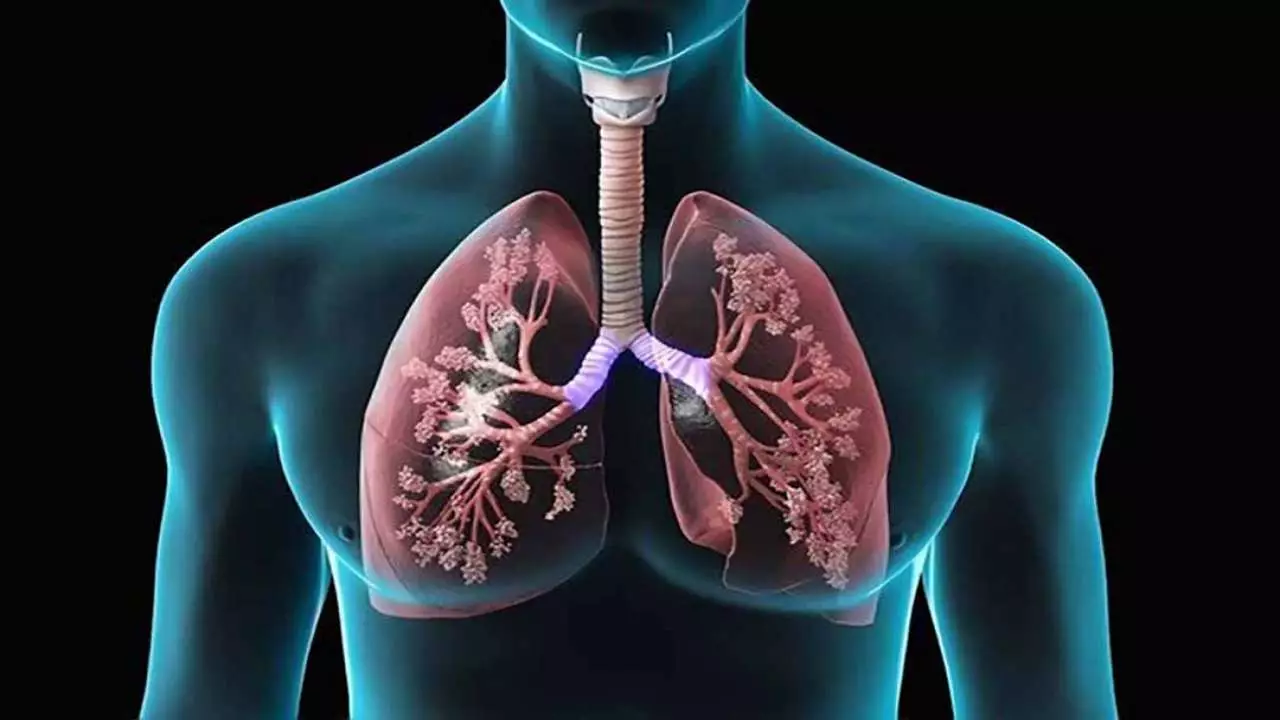 Bệnh lao phổi là gì? Triệu chứng và cách điều trị