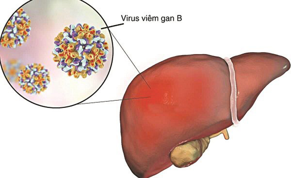 Bệnh viêm gian khi mang thai