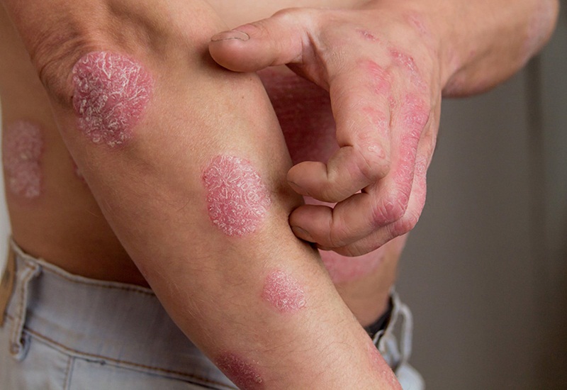 Bệnh chàm (Eczema)