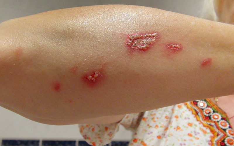 Nếu bạn lo lắng về mức độ nghiêm trọng của vết đốt, hãy tham khảo ý kiến bác sĩ