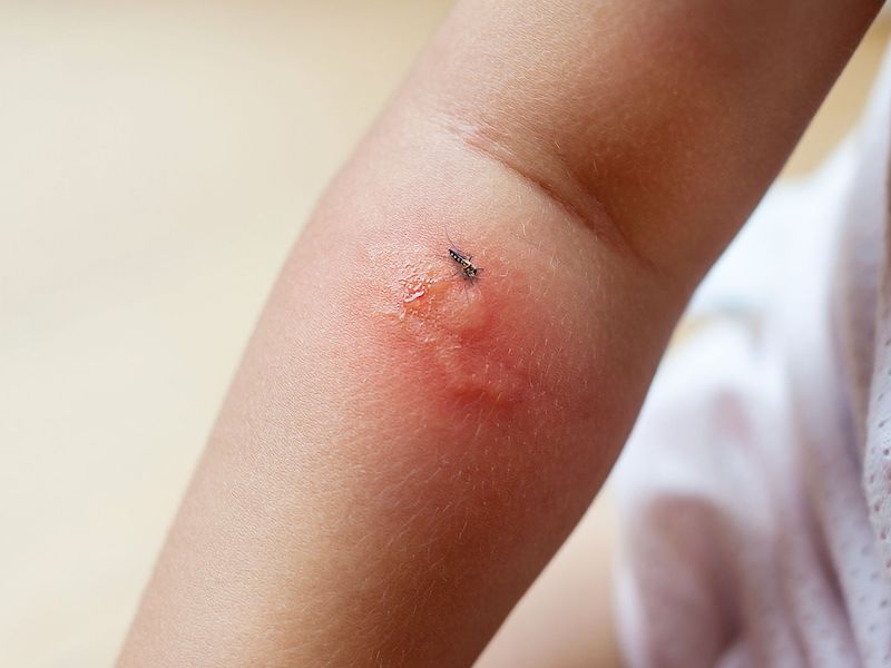 Mẹo làm dịu vết côn trùng cắn nhanh chóng và hiệu quả